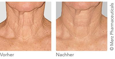 Vorher-/Nachharbild Ultherapy im Bereich des Halses
