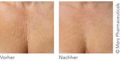 Vorher-/Nachharbild Ultherapy im Bereich des Dekolletès