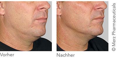 Vorher-/Nachharbild Ultherapy im Bereich der unteren Gesichtshälfte