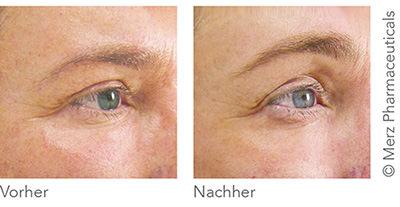 Vorher-/Nachharbild Ultherapy im Bereich der Augen